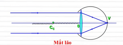 Mắt lão là gì