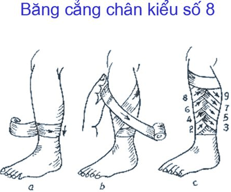 Lý thuyết GDQP 10 Cánh diều Bài 2: Kĩ thuật cấp cứu và chuyển thương (ảnh 7)