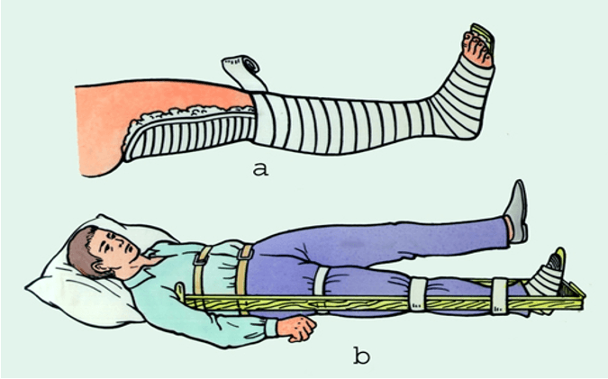 Lý thuyết GDQP 10 Cánh diều Bài 2: Kĩ thuật cấp cứu và chuyển thương (ảnh 12)