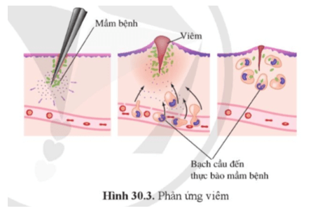 Quan sát hình 30.3 và giải thích tại sao nói viêm là phản ứng miễn dịch