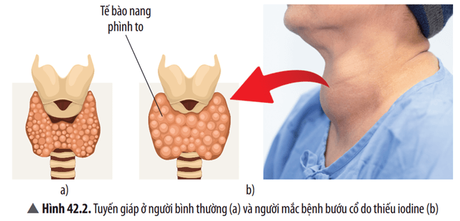 Quan sát Hình 42.2, cho biết tuyến giáp ở người bình thường và người mắc bệnh