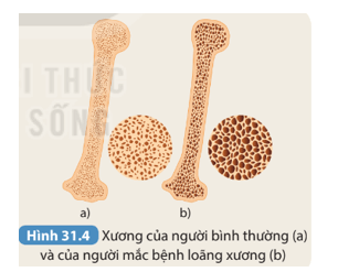 Quan sát Hình 31.4 và dự đoán xương nào bị giòn, dễ gãy