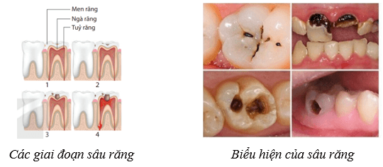 Lý thuyết KHTN 8 Kết nối tri thức Bài 32: Dinh dưỡng và tiêu hóa ở người 