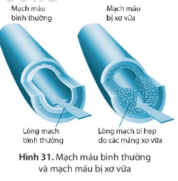 Ở những người có chế độ ăn nhiều dầu mỡ, ít vận động sẽ có nguy cơ mạch máu