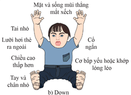 Người bị hội chứng Down có biểu hiện