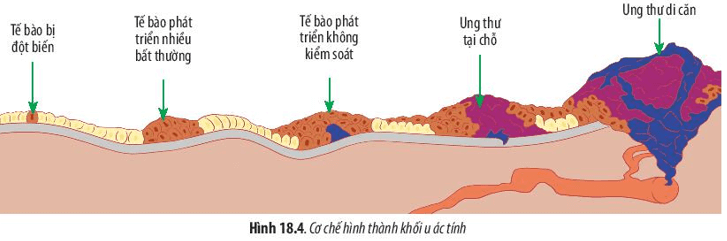 Hãy quan sát Hình 18.4 và cho biết cơ chế hình thành khối u ác tính